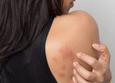 Ulcerative Colitis Rash: Causes, Symptoms, & How To Manage It