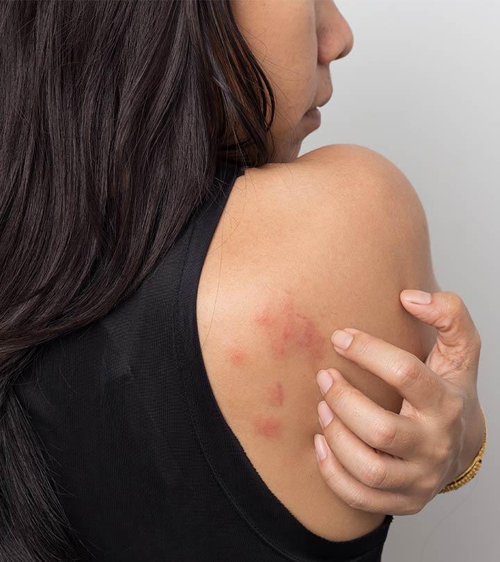 Ulcerative Colitis Rash: Causes, Symptoms, & How To Manage It