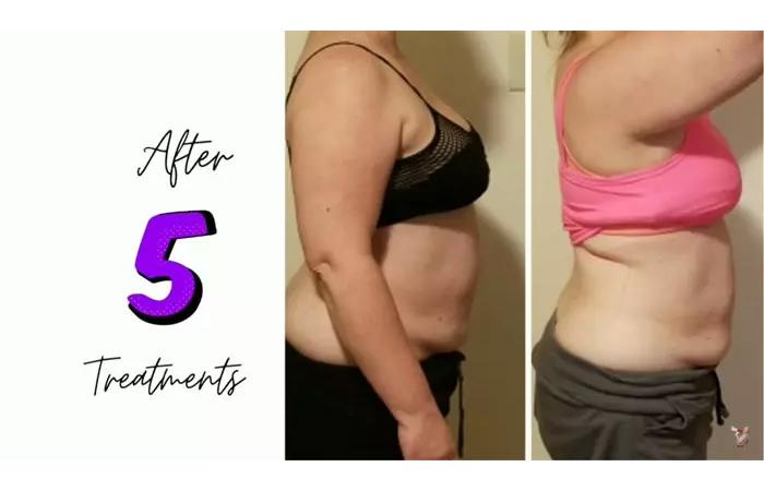 Best At-Home Body Contouring Machine Review + Before and After Results  After 3 Weeks! - Video Summarizer - Glarity