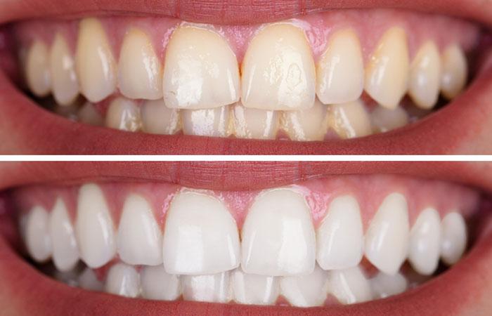 Uv teeth whitening