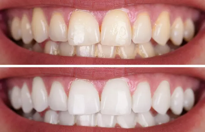 Benefits Of LED Teeth Whitening - LED Teeth Whitening