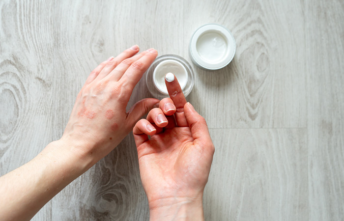 Allantonin may help control eczema