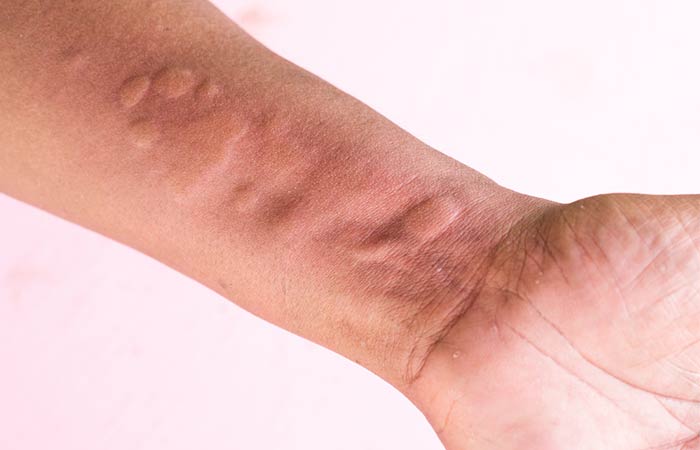 10 Skin Rashes Caused By Ulcerative Colitis