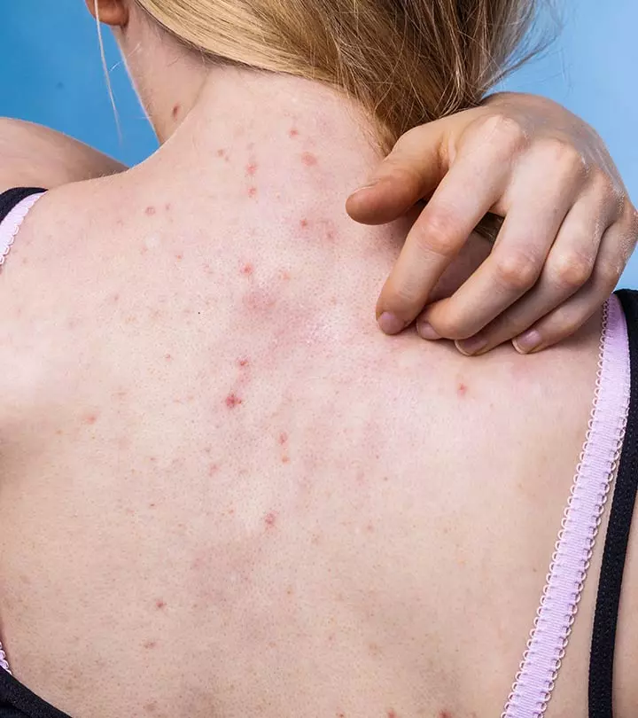 How To Get Rid Of Bacne For Good