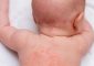 Baby Heat Rash: What Is It, Causes, And How To Prevent It
