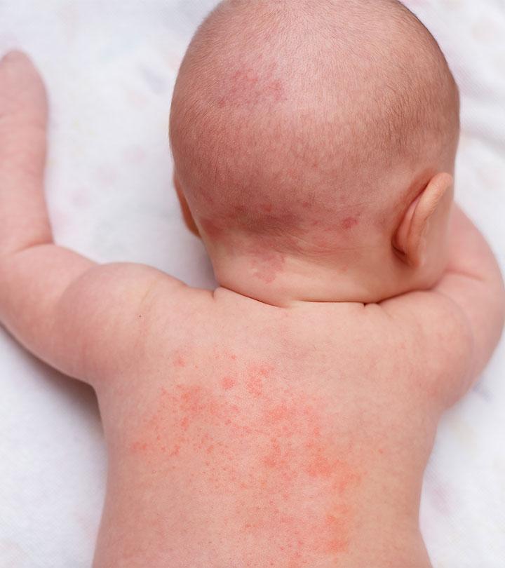 How to get rid of skin rash on baby