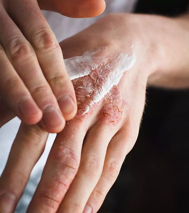 Ichthyosis Vulgaris: Causes, Symptoms, Diagnosis, & Treatment