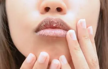 Lips Begin To Crack (Specifically At The Corners)