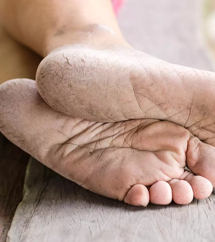 Vinegar Scrub For Dry, Rough, And Cracked Heels