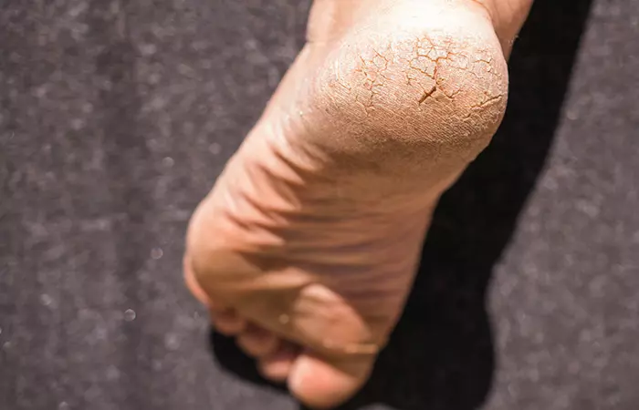 What Are Cracked Heels