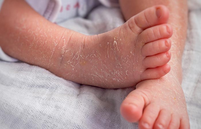 What Are The Symptoms Of Ichthyosis Vulgaris