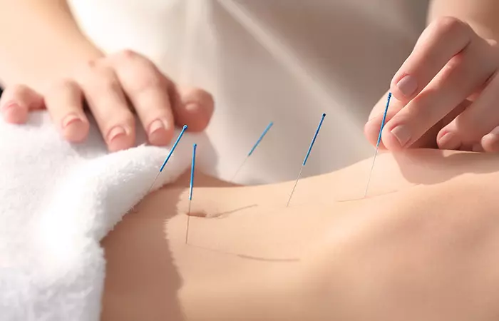 Acupuncture for irritable bowel syndrome