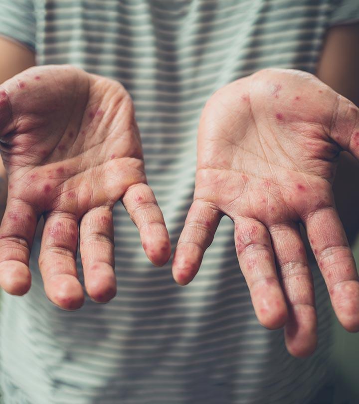 hand foot and mouth disease treatment bath