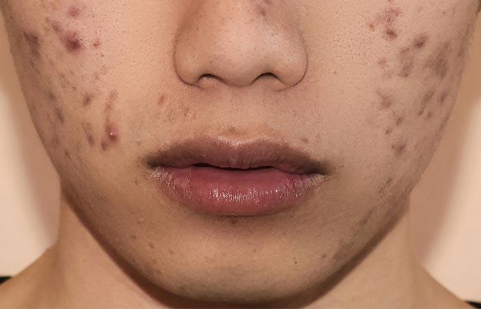 How do pimples occur