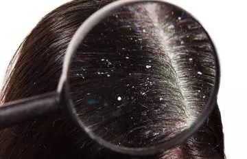 Is Dandruff A Sign Of Deteriorating Scalp Health
