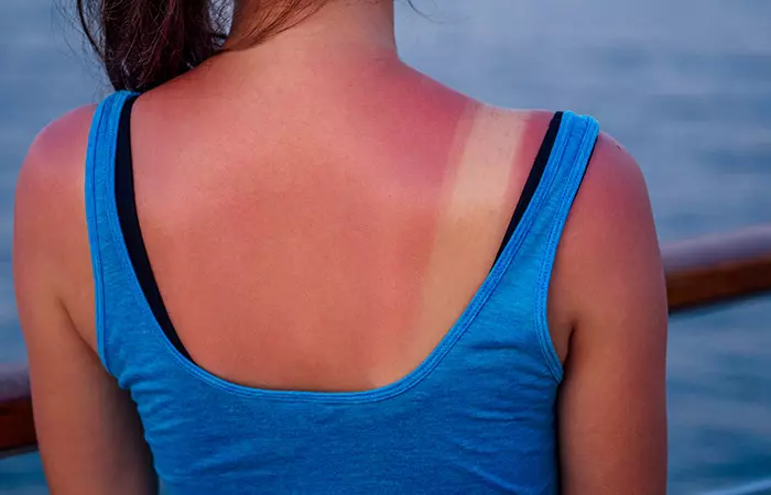 It Alleviates Sun Damage On Skin