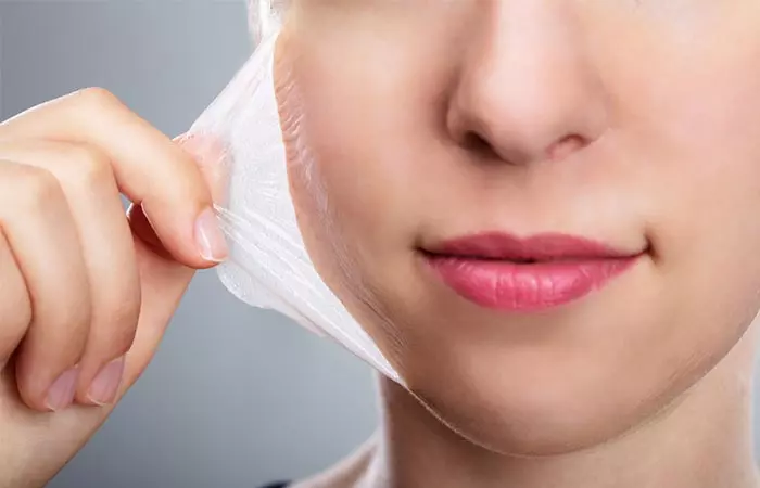 Chemical Peels