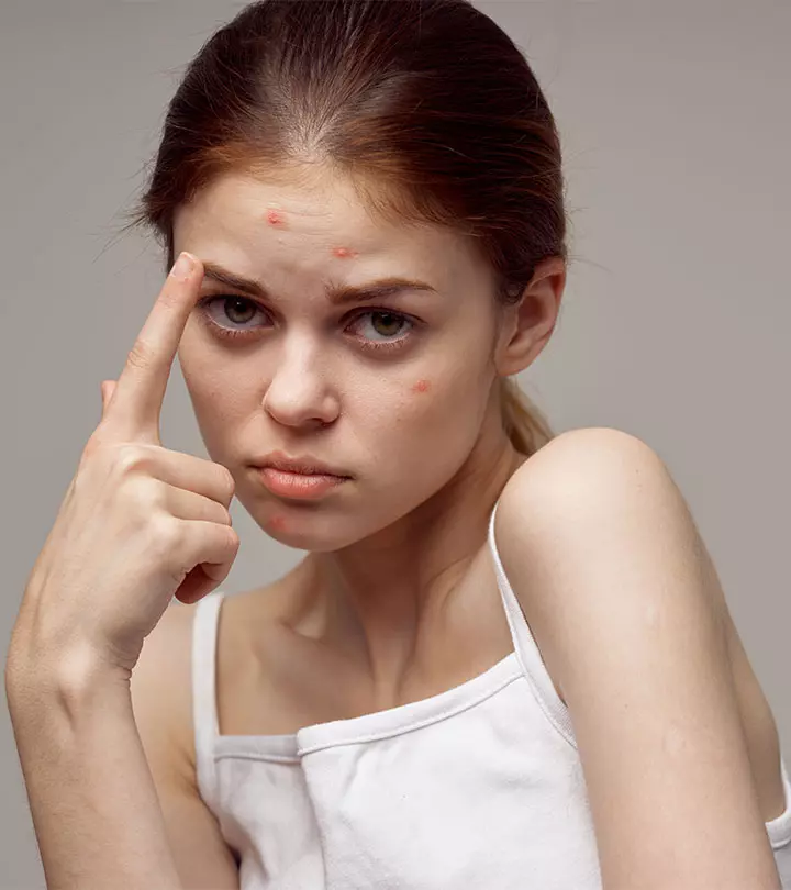 How to Get Rid of Pimple Marks