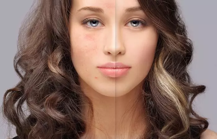 Medical Treatments That Help Get Rid Of Pimple Marks