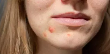The Difference Between An Acne Mark And Acne Scar