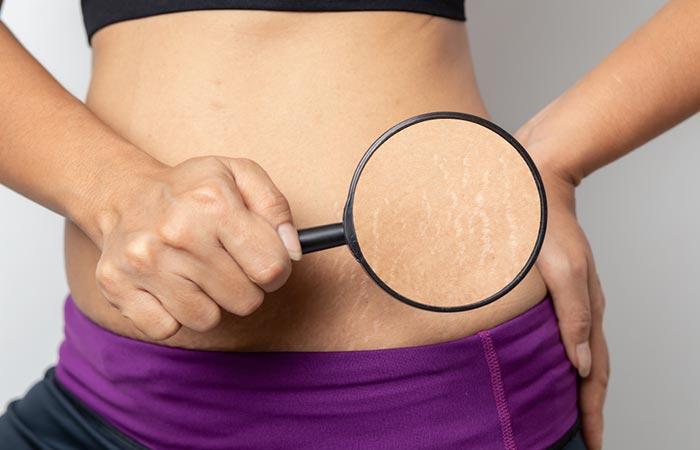 Lemon Honey Helps Get Rid Of Stretch Marks