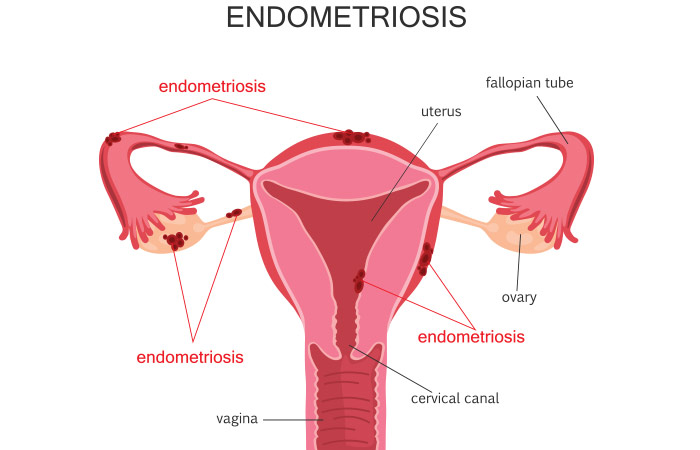 What Is Endometriosis