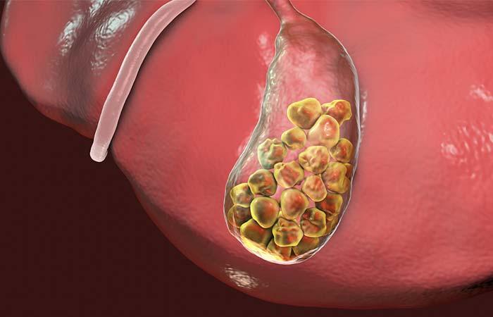 What is Gallbladder Stone in Hindi