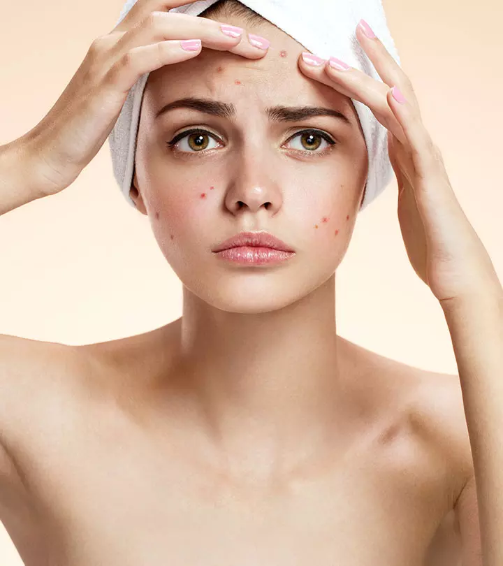 A Study Says That People Who Suffer From Acne Age Slower