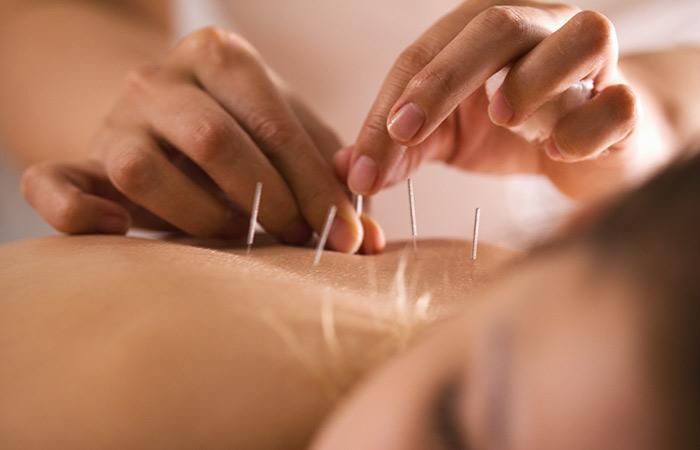 Acupuncture