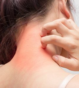Eczema Symptoms and Home Remedies in Hindi