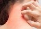 एक्जिमा के कारण, लक्षण और घरेलू उपाय - Eczema Symptoms and ...
