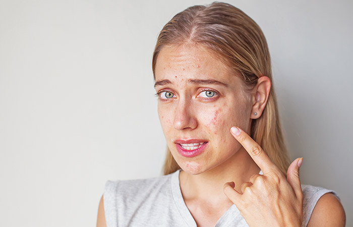 O sal de Epsom é eficaz no tratamento da acne