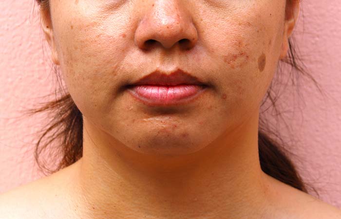 Melasma