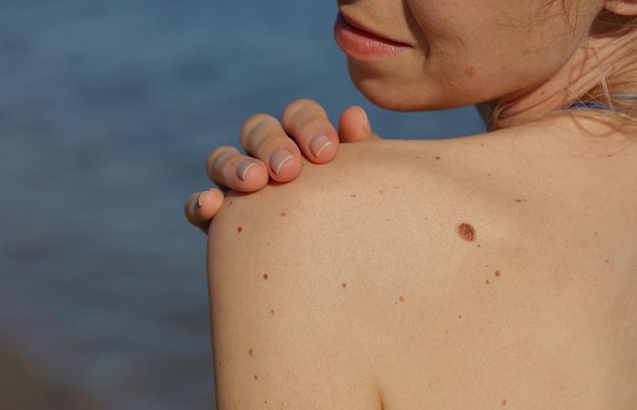 Skin Tags And Lumps