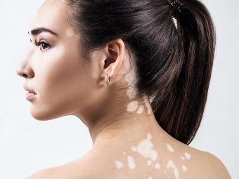 White Spots (Vitiligo) Home Remedies in Hindi