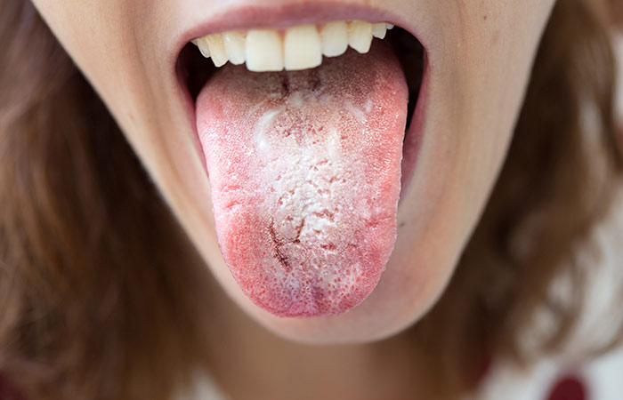 White Tongue