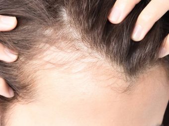 12 Home Remedies for Baldness in Hindi