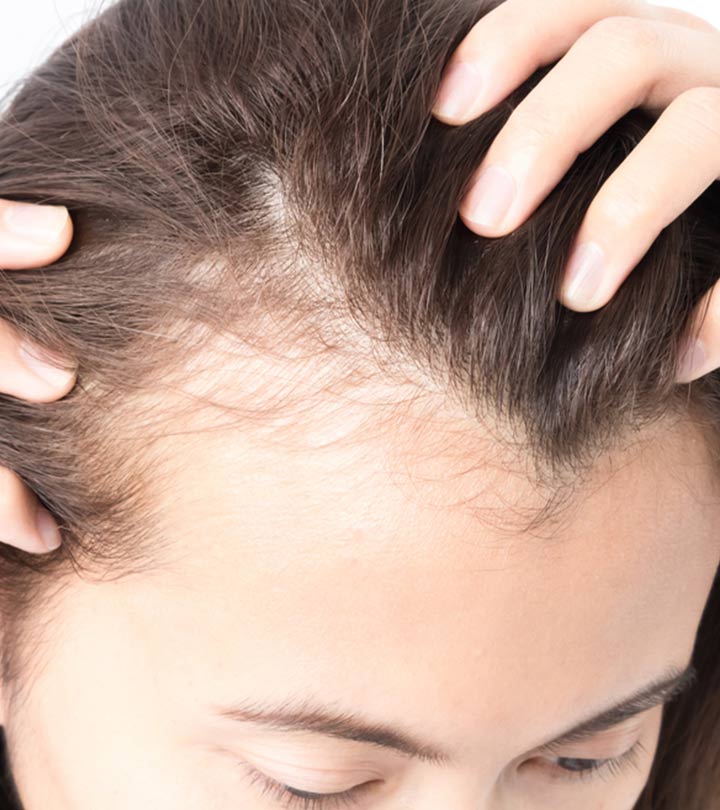 गंजेपन के कारण, लक्षण और घरेलू इलाज – 12 Home Remedies for Baldness in Hindi