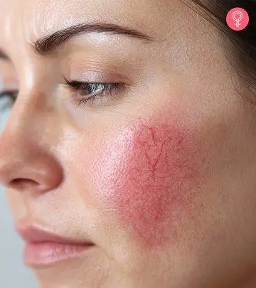 Woman With Broken Capillaries On The Face