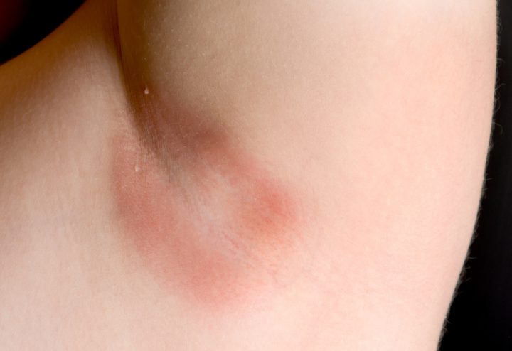 Armpit rash can be itchy and appear red