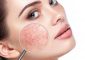 4 Quick Ways To Get Rid Of Broken Capillaries On The Face