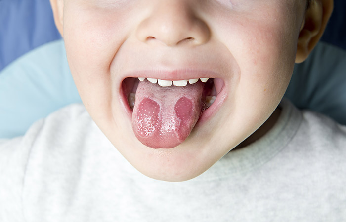 Candida infection in the mouththroat or food system