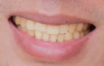 Causes of Yellow Teeth in Hindi