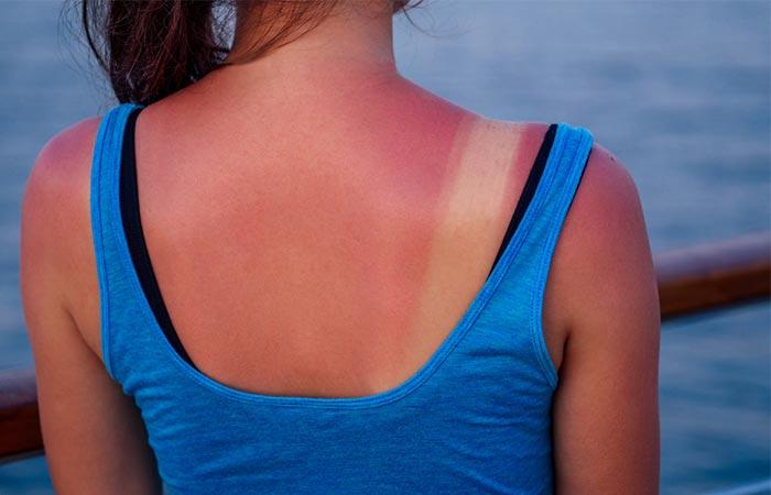 Fixes sunburn