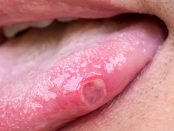 Home Remedies for Tongue Ulcer in Hindi