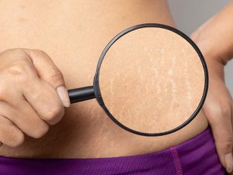 How To Remove Stretch Marks in Hindi