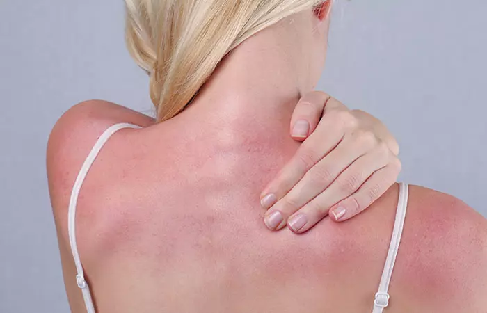 Soothe A Sunburn