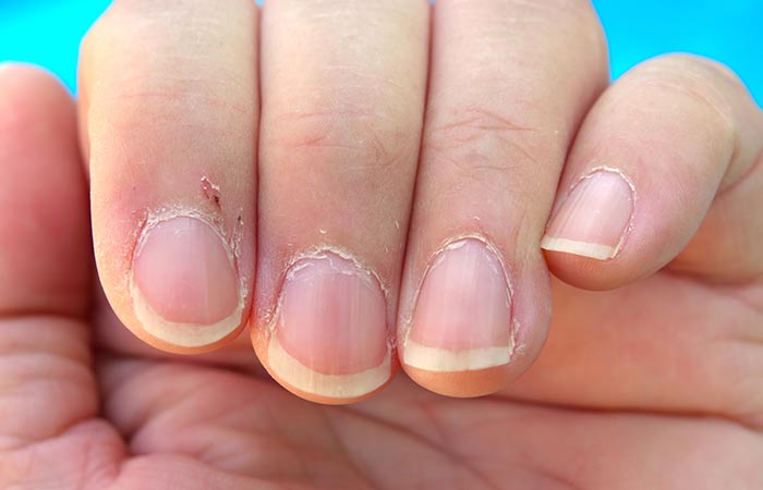 What Causes Cuticles To Dry Out