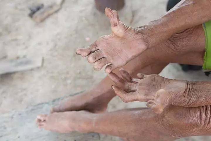 What Exactly Is Leprosy