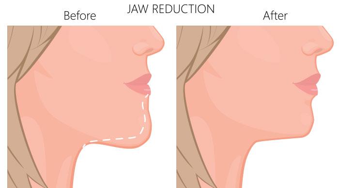 What Is V-Line Jaw Surgery 